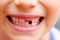 Close up child mouth missing milk teeth