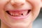 Close up child mouth missing milk tooth