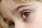 Close-up of a child`s eye stye. Ophthalmic hordeolum disease