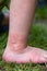 Close-up of a child\'s leg with stinging nettle blisters