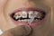 Close up of cleaning dental braces