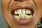 Close up crooked yellow teeth of men