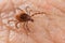 Close-up of deer tick on human skin detail in background. Ixodes ricinus or scapularis