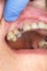 Close-up dental implant wort patient in a dental clinic during treatment. The concept of surgical aesthetic dentistry