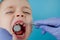 Close up of dentist`s hands with assistant in blue gloves are treating teeth to a child, patient`s face is closed