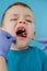 Close up of dentist`s hands with assistant in blue gloves are treating teeth to a child, patient`s face is closed