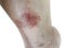 Close up dermatitis on skin, ill allergic rash dermatitis eczema skin of patient , atopic dermatitis symptom skin detail texture ,