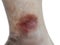 Close up dermatitis on skin, ill allergic rash dermatitis eczema skin of patient , atopic dermatitis symptom skin detail texture ,