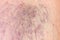 Close-up of dermis with varicose veins