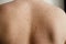 Close up detail of the bare skin on a man back with scattered moles and freckles , Disorders of body , Checking benign