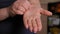 Close-up of a diabetic woman with dry skin scratching her hands.