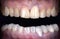 Close Up Dirty crooked yellow Teeth  young lady oral, female  woman inter dental . Dental restoration surgery concept . Health de