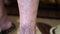 Close up of elderly woman leg with varicose veins. Lifestyle