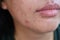 Close up the face skin Asian young women are acne, facial skin, acne, clogged scars caused by acne. Medical