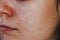 Close-up of a female face: problematic oily skin, enlarged pores, redness, acne, black spots