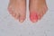 Close-up of female feet, toe of left bare foot is inflamed and enlarged, problem of rheumatoid arthritis, chronic inflammation of