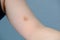 Close-up female hand with darkened bruise on delicate skin, shoulder injury, life safety concept, physical abuse