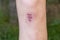 Close up of female knee with a scar