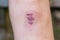 Close up of female knee with a scar