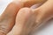 Close-up female sore skin of feet, dry heels on a white background with copy space.