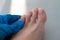 A close-up of a foot with a fungus on the nails is examined by a doctor in gloves. Onycholysis: detachment of the nail from the