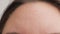 Close-up. Forehead of a young woman of Caucasian appearance. Peeling of the skin. Peeling