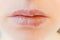 Close up of girl lips affected by herpes. Treatment of herpes infection and virus. Part of young woman face, lips with herpes