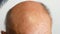 Close-up of hairless head of Caucasian elderly man. Hair loss problem. Procedures for restoring hair on the head. Man combing bald