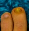 Close up of healthy and a fungus infected toe nail, Common nail infection and disease
