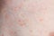 Close up image of a little boy`s body suffering severe urticaria, nettle rash also called hives