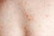 Close up image of a little boy`s body suffering severe urticaria, nettle rash also called hives