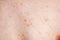 Close up image of a little boy`s body suffering severe urticaria, nettle rash also called hives