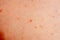Close up image of a little boy`s body suffering severe urticaria, nettle rash also called hives