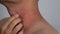 Close up image of skin texture suffering severe urticaria or hives