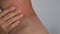 Close up image of skin texture suffering severe urticaria or hives or kaligata on neck.