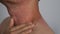 Close up image of skin texture suffering severe urticaria or hives or kaligata on neck.