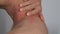 Close up image of skin texture suffering severe urticaria or hives or kaligata on neck.