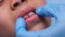 Close-up inside the oral cavity of a healthy child with beautiful rows of baby teeth.