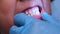 Close-up inside the oral cavity of a healthy child with beautiful rows of baby teeth.