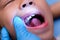 Close-up inside the oral cavity of a healthy child with beautiful rows of baby teeth. Young girl opens mouth revealing upper and