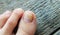 Close-up of a leg with a fungus on nails on a wooden background