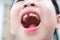 Close up of lost teeth in the mouth of young  Asia boy 6 years old