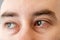 Close-up of male brown eyes with bruises, redness and burst vessels. The concept of irritation, inflammation and