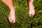 Close-up of a male foot with peeling skin on a green grass. Avitaminosis. Disease. Dry problematic skin on the feet. Health care