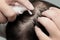 Close up of maleâ€™s hand using medication on scalp, treating for Alopecia, hair loss, dandruff or hair problem