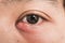 Close up of man eye stye