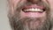 Close up of man`s bearded face. Man smiles and shows his teeth with fillings after visiting dentist.