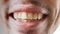 Close-up. Man smiles showing his crooked and yellow teeth. Dental care concept