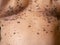 Close-up many large big brown nevus on human chest skin body