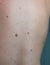 Close up the melanoma black spot on human skin.